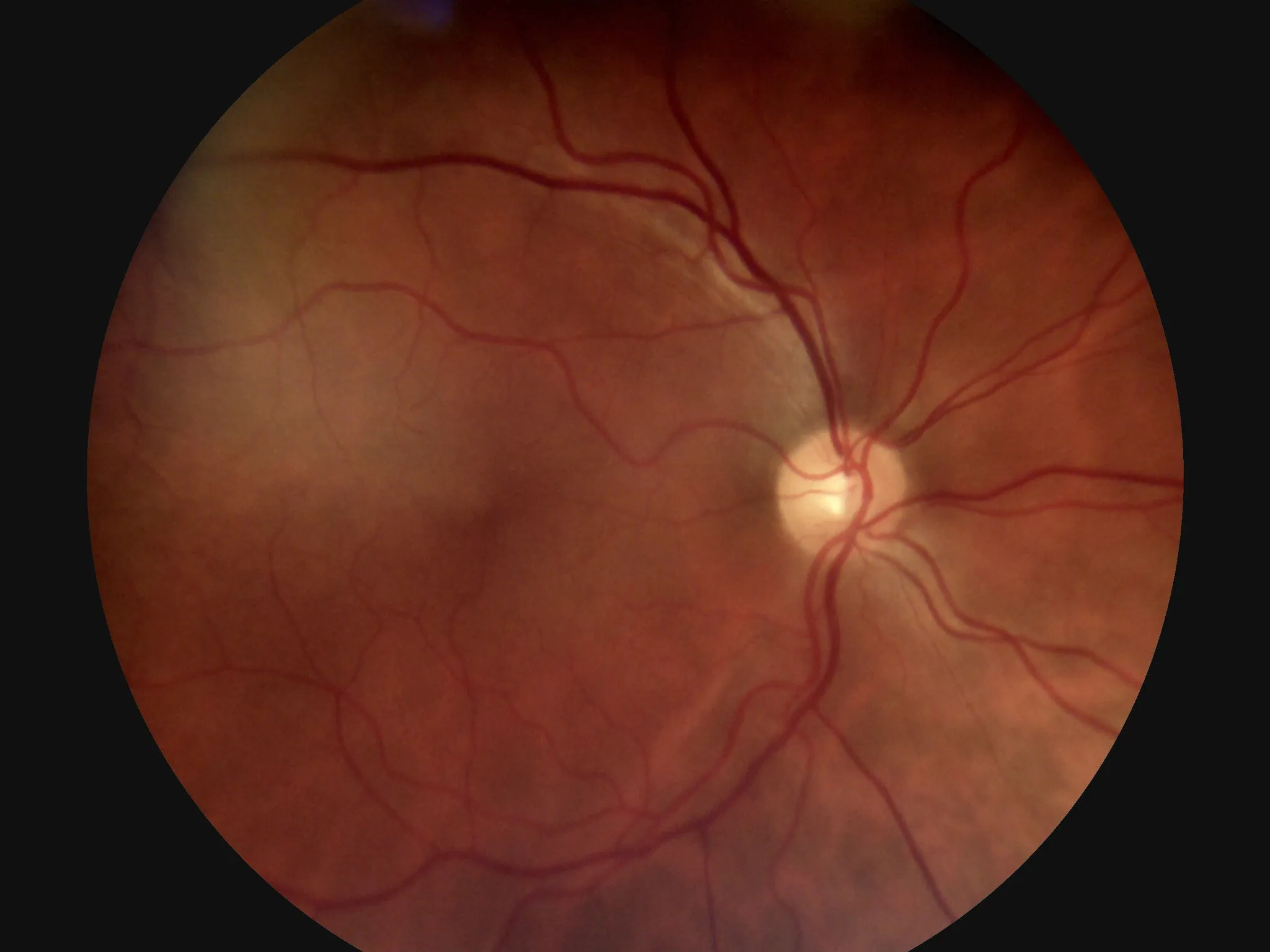 45° Auto Focus Portable Fundus Camera